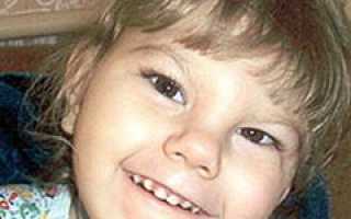 Микроцефалия